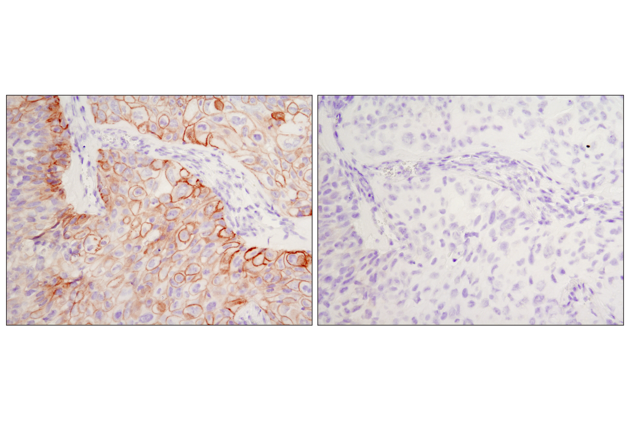 Immunohistochemistry Image 1: Phospho-EGF Receptor (Tyr1068) (D7A5) XP® Rabbit mAb