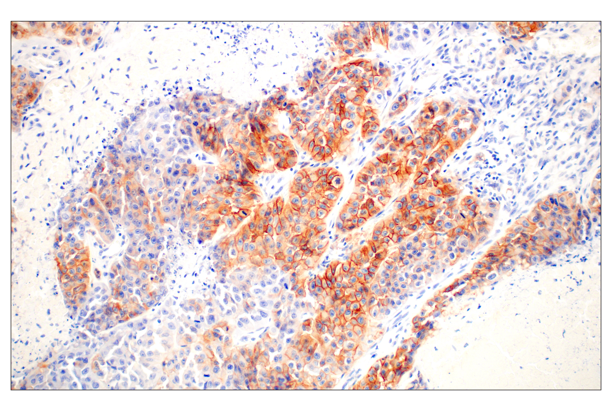 Immunohistochemistry Image 1: EGF Receptor (D38B1) XP® Rabbit mAb