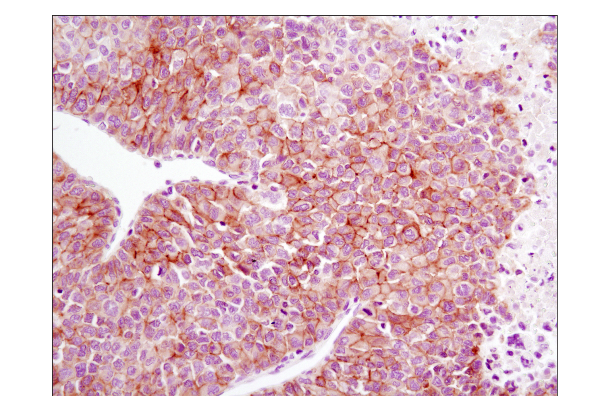 Immunohistochemistry Image 2: EGF Receptor (D38B1) XP® Rabbit mAb