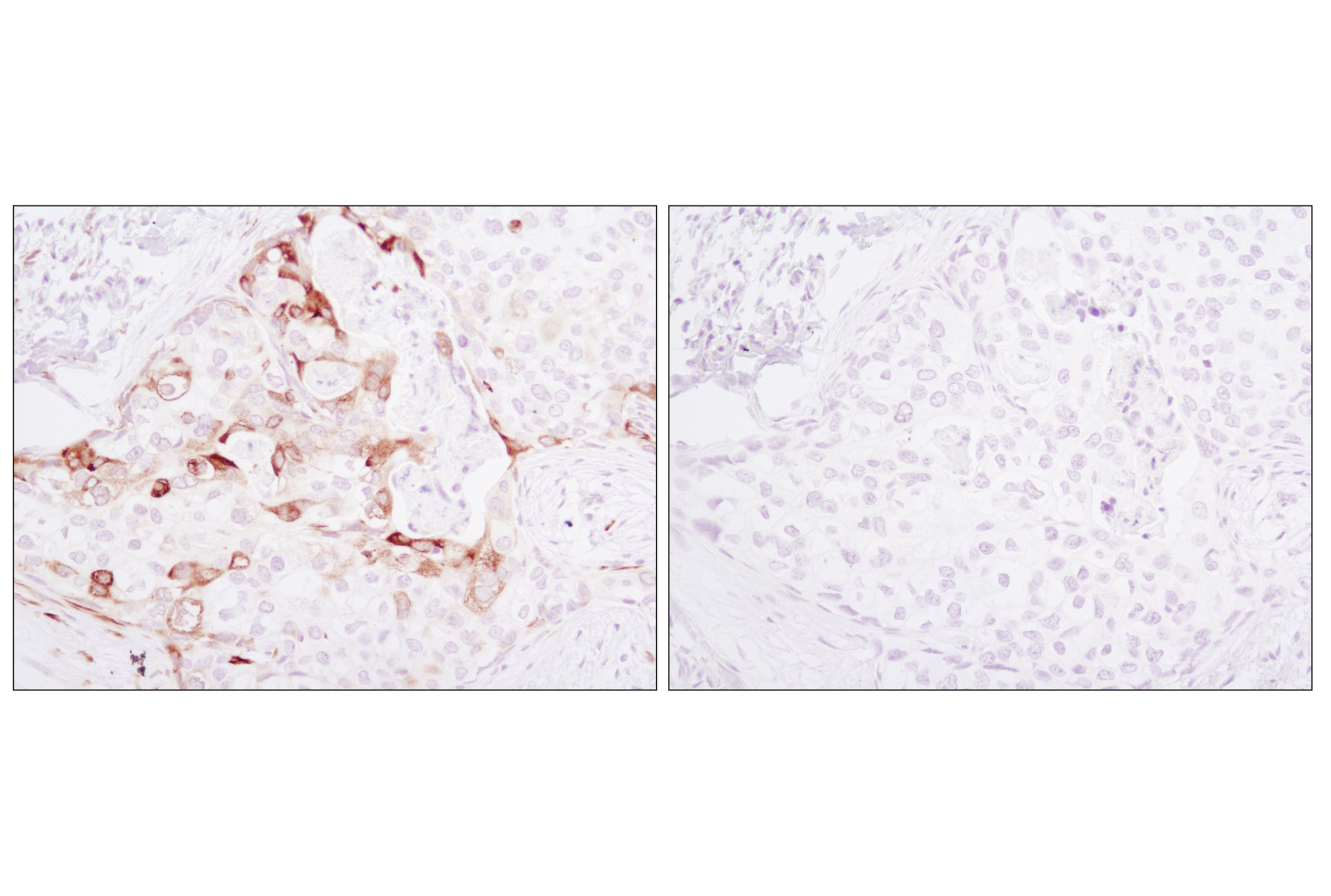 Immunohistochemistry Image 4: Phospho-S6 Ribosomal Protein (Ser235/236) (D57.2.2E) XP® Rabbit mAb (BSA and Azide Free)